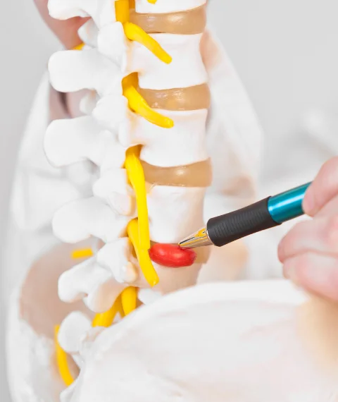 Queen Creek Arizona Chiropractic Herniated Disc Treatment